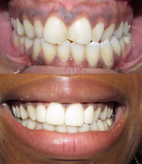 Veneers Encinitas, California Dr. John Maroon, DDS